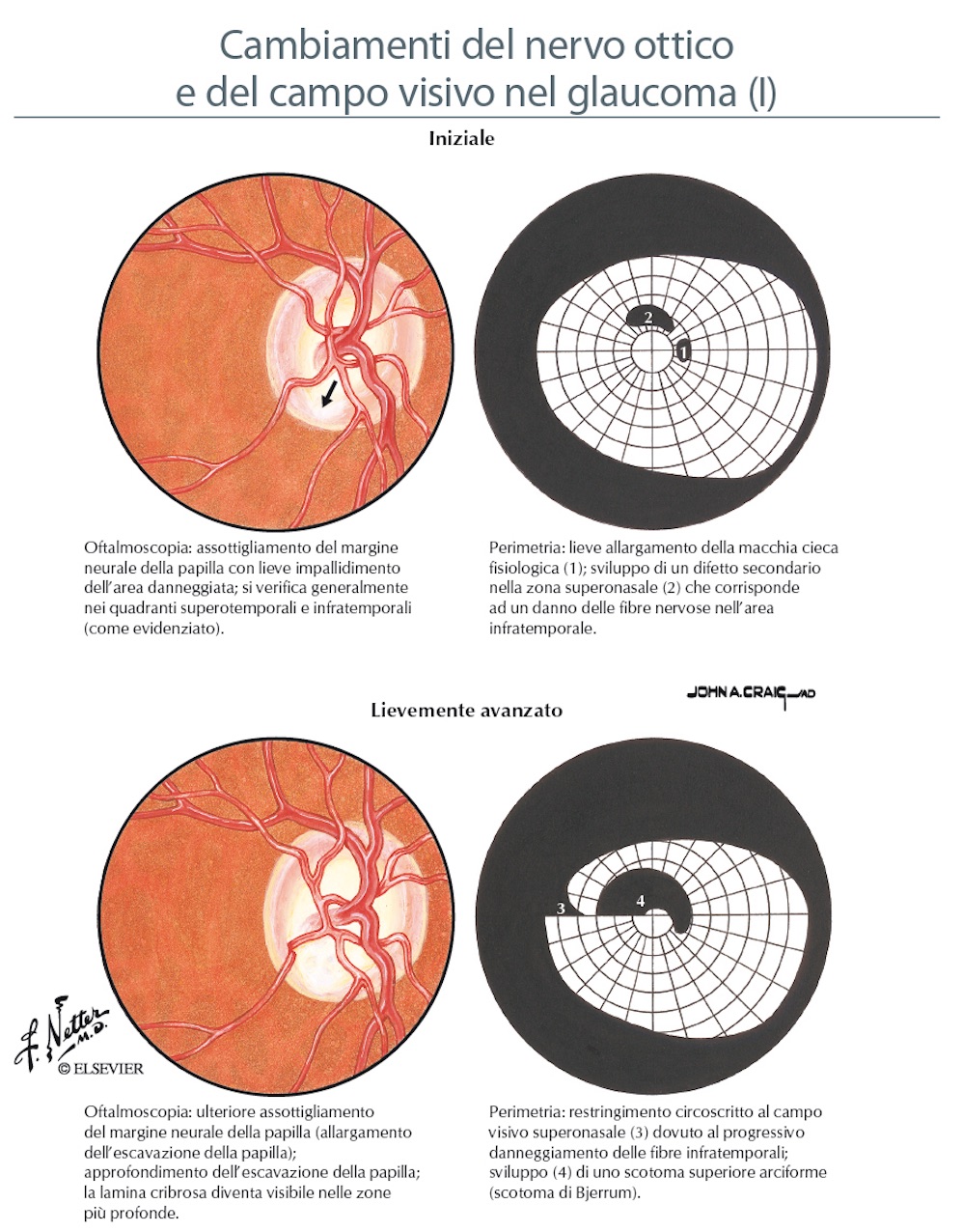 GLAUCOMA INIZIALE