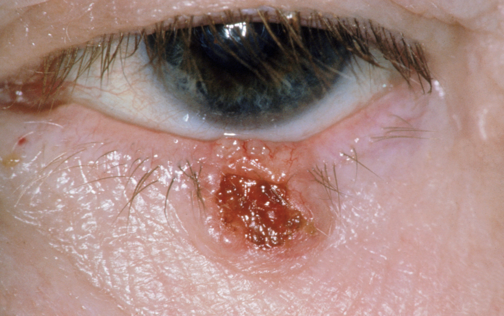 human papillomavirus infection on finger papiloame la o femelă